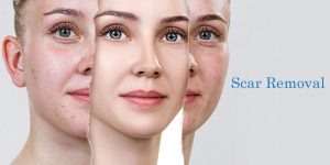 Cost for scar removal in India -Venkateshwar Hospital