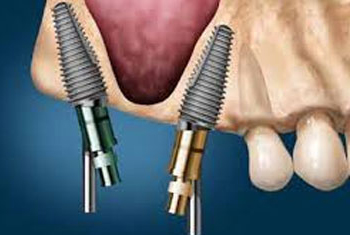 Dental implant pants utilising nobel Implants